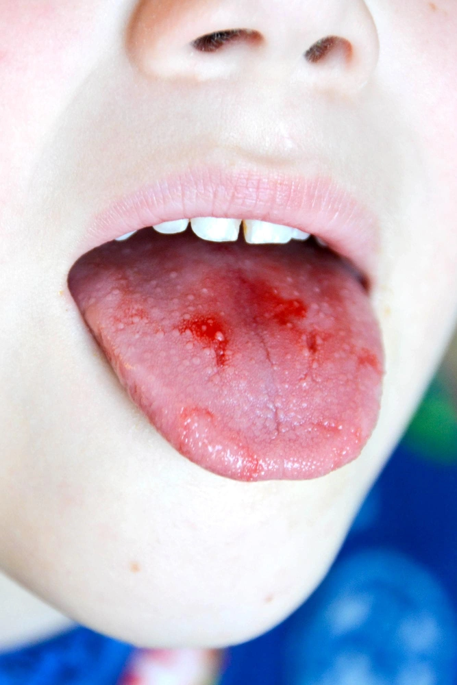 tongue cancer