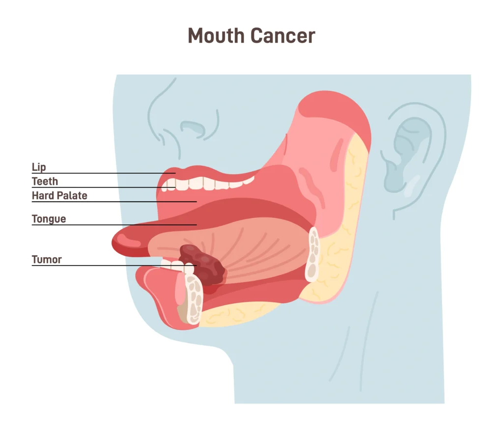5. The Importance of Early Detection in Oral Cancer