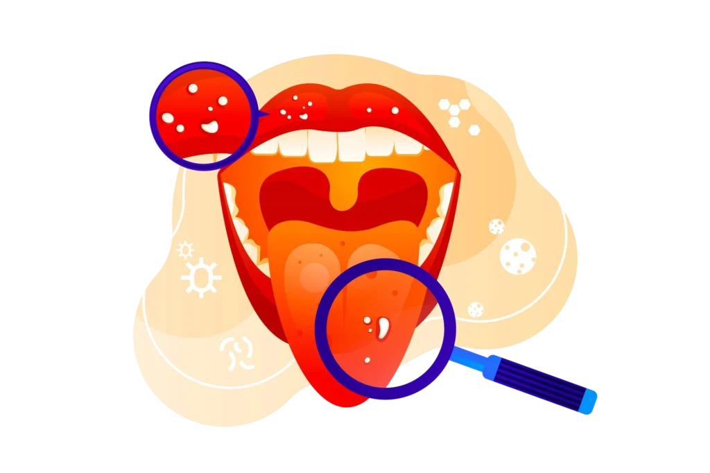 Advanced Chemotherapy for Oral Cancer Treatment