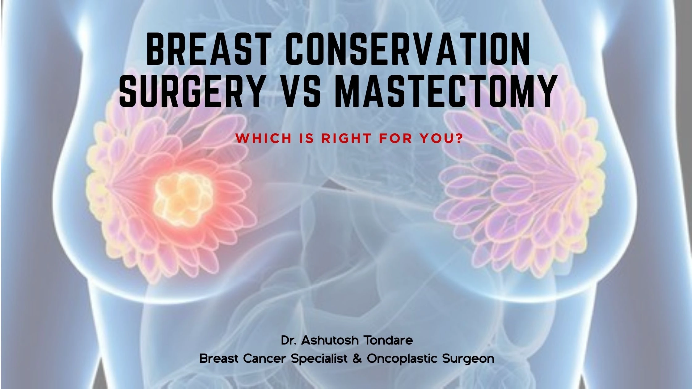 Breast Conservation Surgery vs Mastectomy: Which Is Right for You?