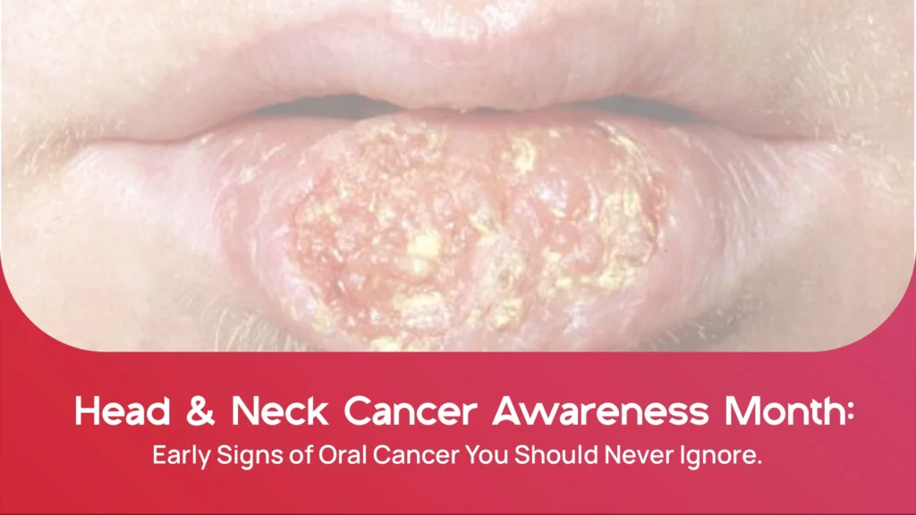 Head & Neck Cancer Awareness Month: Early Signs of Oral Cancer You Should Never Ignore