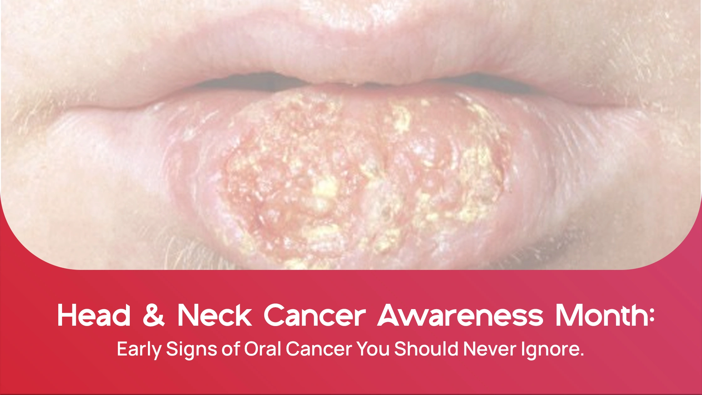 Head & Neck Cancer Awareness Month: Early Signs of Oral Cancer You Should Never Ignore
