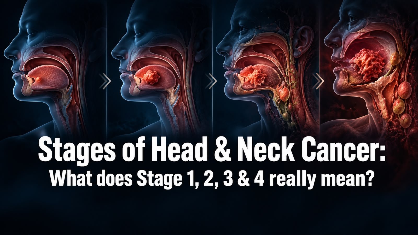 Stages of Head & Neck Cancer: What Does Stage 1, 2, 3 or 4 Really Mean?